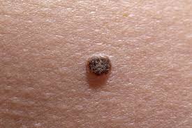 Psoriasis is a skin condition that causes some are. 758 Malignant Melanoma Photos Free Royalty Free Stock Photos From Dreamstime