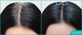 It's normal for females (and males) to produce androgens, which are a group of hormones important for general health. Pcos Hair Loss Best Treatments Regrow Los Hair