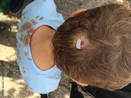 Herida En La Cabeza De Un Nino Tras Una Caida Foto De Stock Adobe Stock