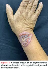 Image result for Pathergy