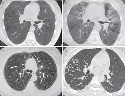 Zorgen om legionella in uw gebouw of wilt u preventief een inspectie laten uitvoeren? Small Airways Diseases Excluding Asthma And Copd An Overview European Respiratory Society