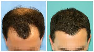 Hair Transplant 3 Months Post Surgery Results Before And