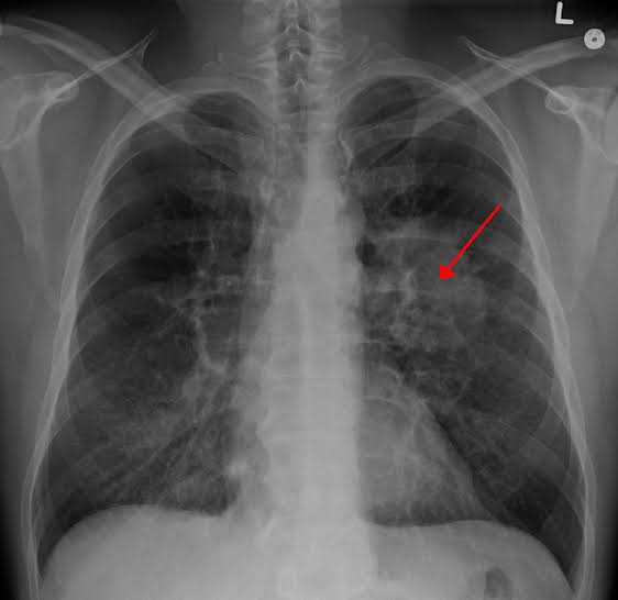 Chest X-ray imaging used to detect mesothelioma