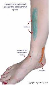 Shin Splints Causes Contributing Factors And Treatment Options Myfootshop Com