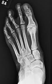 They didnt know what the problem was. Orthotic Management Tactics For Hallux Limitus Lower Extremity Review Magazine