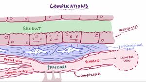 Pin On Cirrhosis Info