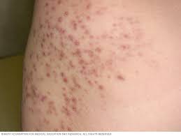 These hairs can form itchy and infected bumps that can be painful and can also. Folliculitis Symptoms And Causes Mayo Clinic