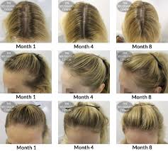 However, my hair loss worsened, following the same pattern as some members already noticed. What Causes Hair Loss Galhairs