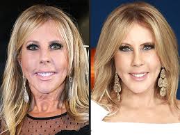 Real Housewives Of Orange County Vicki Gunvalson Post Plastic Surgery Face Celebrity Plastic Surgery Vicki Gunvalson Plastic Surgery