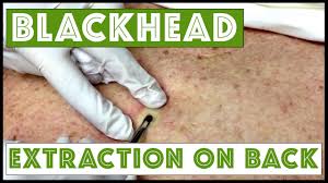 The ~amazing~ blackhead removal you see in videos isn't actually as impressive as it seems. Best Dr Pimple Popper Blackhead Extraction Videos Ever
