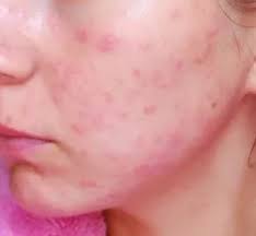 La Alergia A La Miel En Los Ninos Caracteristicas Foto Tratamiento