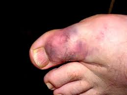 We did not find results for: How To Get Crutches For A Sprained Broken Big Toe As A Teen In Quarantine Quora