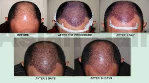 Patients have achieved about 80% of the hair growth of the transplanted hairs. Hair Transplantation Surgery Frequently Asked Questions Dr Arambulo