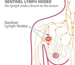 You should feel the bones and have testing done for cancer. Lymph Node Removal Lymphedema National Breast Cancer Foundation