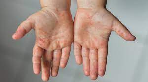 Hand Fuss Mund Krankheit Beim Baby Symptome Ursachen Und Behandlung