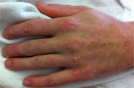 And body aches, occasionally with a skin rash and swollen lymph glands. West Nile Virus Encephalitis In Gata2 Deficiency Allergy Asthma Clinical Immunology Full Text