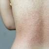 Symptoms of roseola in baby. 1