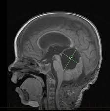 Morning headache or headache that goes away after vomiting. Atypical Teratoid Rhabdoid Tumor At Rt In Children Together