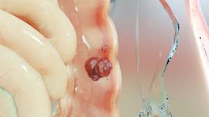 Image result for Blood in stool