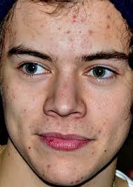 Pin On Men Acne Treatment