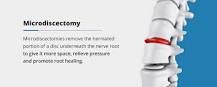 Image result for what is the treatment for spinal fusion of the spine