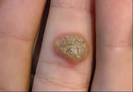 Verrugas Mezquinos Dermatologo En Los Cabos Bcs