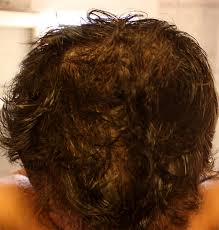 When you're experiencing hair loss, there are lots of products you can use to help slow down the rate of loss and to make hair grow fuller and thicker. Tretinoin Minoxidil Finasteride Ketoconazole Cream 2