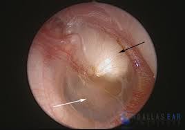 The tympanic membrane is a thin tissue that divides your middle ear and outer ear canal. Cholesteatoma Case Photo Education Dallas Ear Institute