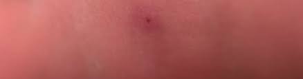 Image result for wolf spider bite skin