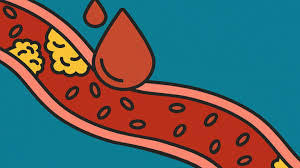 Other members of the family can be tested for fh, and those with the disorder can take steps to lower their chances of developing and dying from heart disease. 10 Things To Know About Inherited High Cholesterol And Genetics Everyday Health