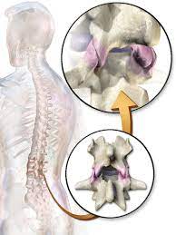 Facet Syndrome Wikipedia