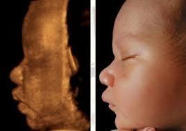 Wann ist der ideale zeitpunkt für ein 3d ultraschallbild? Vorher Nachher Wie Realistisch Waren Die Ultraschallbilder Unserer Baby S Oktober14 Club Fur Ordnungsfanatiker Babycenter
