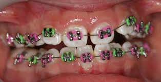 How much does it cost to get orthodontic braces? Braces Firstbite Dental Essendon Dentist Essendon Melbourne Orthodontics