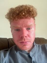 Man, 26, covered in horror 'chemical' rashes diagnosed with incurable  disease