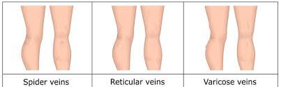 Can You Sleep In Compression Socks Full Answer