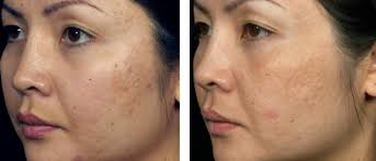 Please contact our office today to schedule your initial consultation. Acne Scars Philadelphia About Face Skincare
