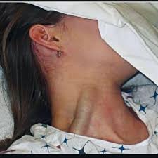 Possibility of heart failure, particularly congestive heart ...