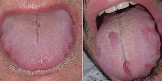 Clinically proven results · reverses early gum damage What Is Covid Tongue Swollen Sore Tongue May Be Possible Coronavirus Symptom