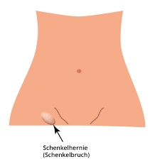 Schenkelhernie Entstehung Symptome Behandlung