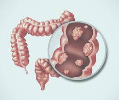 Image result for Anal Cancer