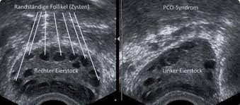 Alle fertilovit® produkte werden nach orthomolekularen grundsätzen hergestellt. Ultraschallbild Pco Syndrom Perlenkette Any Working Mom