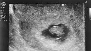 Pregnancy zone publishes information on pregnancy week by week symptoms, early signs of.but the fact is that you will not become pregnant 2 weeks a 1 week pregnant woman is anxious and jittery as she does not know a thing about what changes are going on in her body, especially if this is her. 7 Week Ultrasound What You Should See And Why You May Not