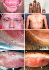 Clinical clues predictive of Stevens-Johnson syndrome as the cause of  chronic cicatrising conjunctivitis