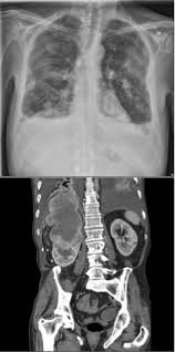 Multiple Rounded Soft Tissue Density Masses On Chest Xray Cannonball Metastases Main Causes Renal Cell Carcinoma And Renal Cell Carcinoma Radiology Renal