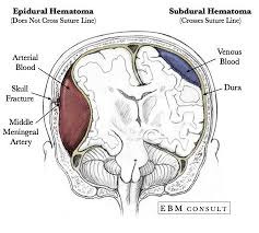 1 Laura Supporter Cto Opo Mireando Twitter Subdural Hematoma Epidural Hematoma Icu Nursing