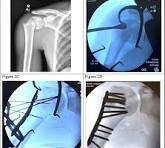 Proximal Humerus Fracture Fixation: Surgical Technique ...