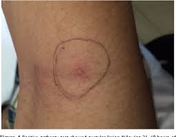 Image result for Pathergy