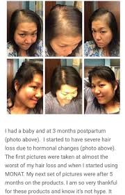 This kind of hair loss is called telogen effluvium. Pin By Laurie Stearman Dempsay On Hair Restoration Postpartum Hair Loss Hair Loss Severe Hair Loss