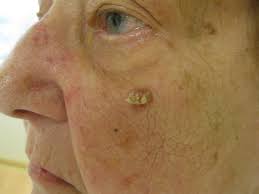 Merkel cell carcinoma (mcc) usually starts on areas of skin exposed to the sun, especially the face, neck, arms, and legs, but it can occur anywhere on the merkel cell carcinoma is rare, and it can look like many other, more common types of skin cancer or other skin problems when it first appears. Squamous Cell Carcinoma Of The Skin Dermatology Advisor