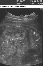 Prenatal Sonographic Patterns In Autosomal Dominant Polycystic Kidney Disease A Multicenter Study Brun 2004 Ultrasound In Obstetrics Amp Gynecology Wiley Online Library